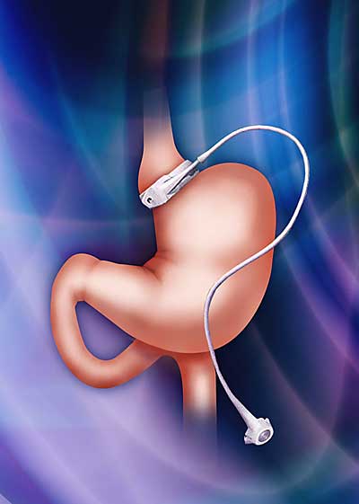 Laparoscopic Adjustable Gastric Banding Laparoscopic Adjustable Gastric Banding