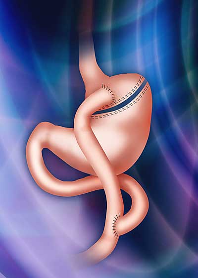 Laparoscopic Gastric Bypass Laparoscopic Gastric Bypass