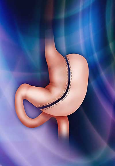 Laparoscopic Vertical Sleeve Gastrectomy Laparoscopic Vertical Sleeve Gastrectomy