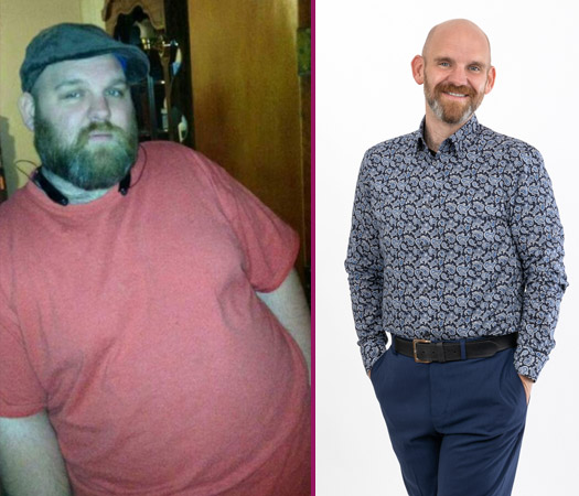 Darwin's Before and After Bariatric Surgery Photo