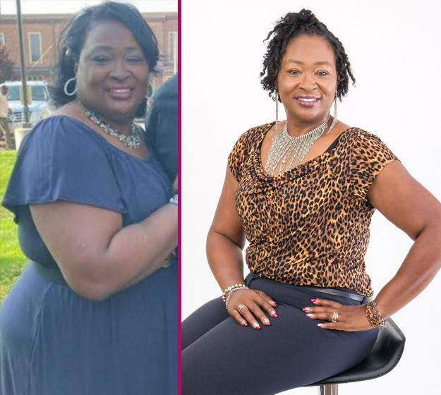 Dorthy's Before and After Bariatric Surgery Photo