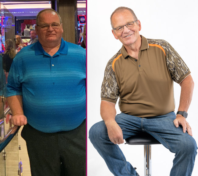 Jim's Before and After the Gastric Sleeve Procedure Photo 