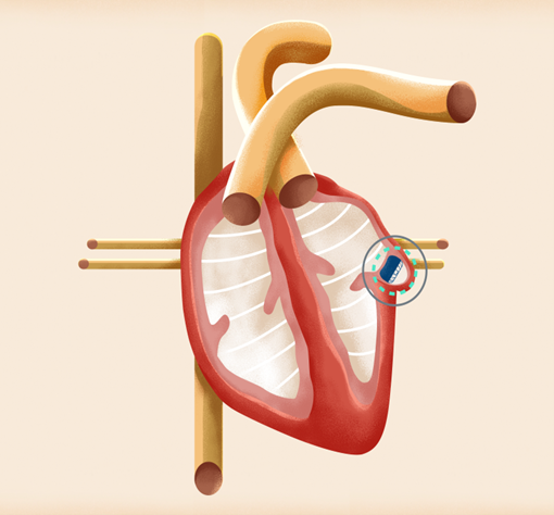 LAAO procedure graphic showing where the implant goes in the heart